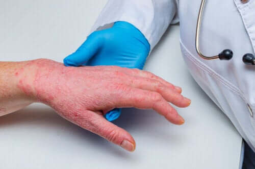Dermatite des mains : symptômes et traitements