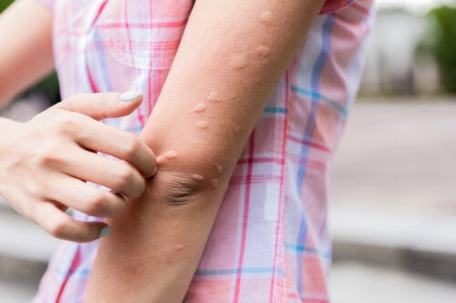 Éruption cutanée sur le bras : causes possibles et traitements