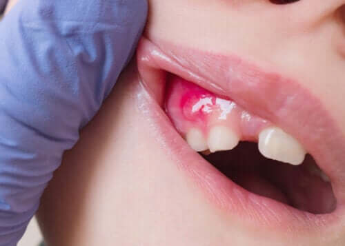 Fistule dentaire : caractéristiques, symptômes et traitement