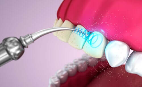 Nettoyage dentaire par ultrasons : bienfaits et inconvénients