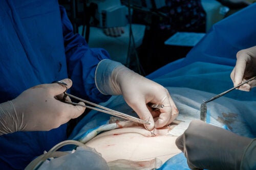 Greffe de peau : quand y a-t-on recours ?