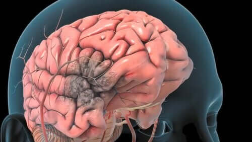 Thrombose artérielle cérébrale : caractéristiques, causes, symptômes et traitement