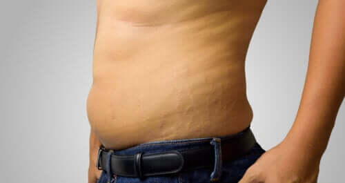 Vergetures chez les hommes : causes et solutions pour les atténuer naturellement