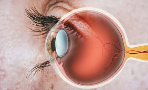 Aphakie : causes et traitement