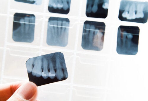 Qu'est-ce que l'ankylose dentaire et comment la traiter ?