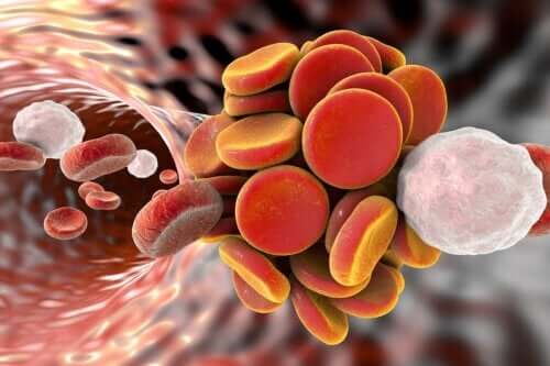 Syndrome des antiphospholipides : causes, symptômes et traitements