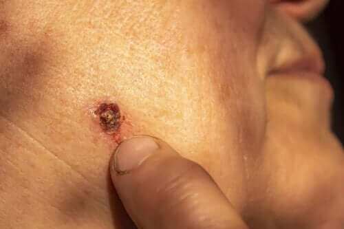 Le carcinome basocellulaire : le cancer de la peau le plus fréquent