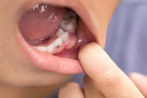 Les symptômes d'une infection dentaire se propageant au corps