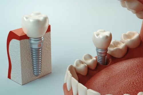 Qu'est-ce que l'ostéointégration des implants dentaires ?