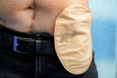 Conseils pour le quotidien après une stomie