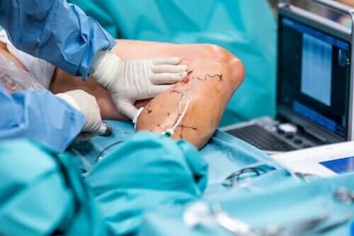 Chirurgie endolaser des varices : en quoi consiste-t-elle et quels sont ses avantages ?