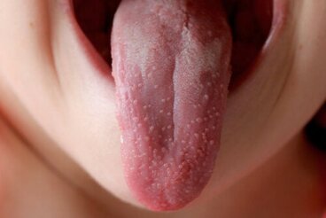 Pourquoi l'inflammation des papilles gustatives se produit-elle ?