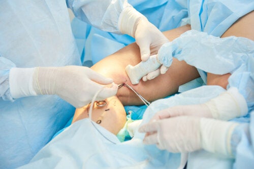 Sclérothérapie des varices : comment se déroule-t-elle ?