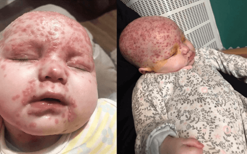 Une fillette de six mois contracte l'herpès après un baiser