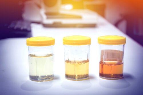Urine foncée ou trouble : 11 causes possibles et leur traitement