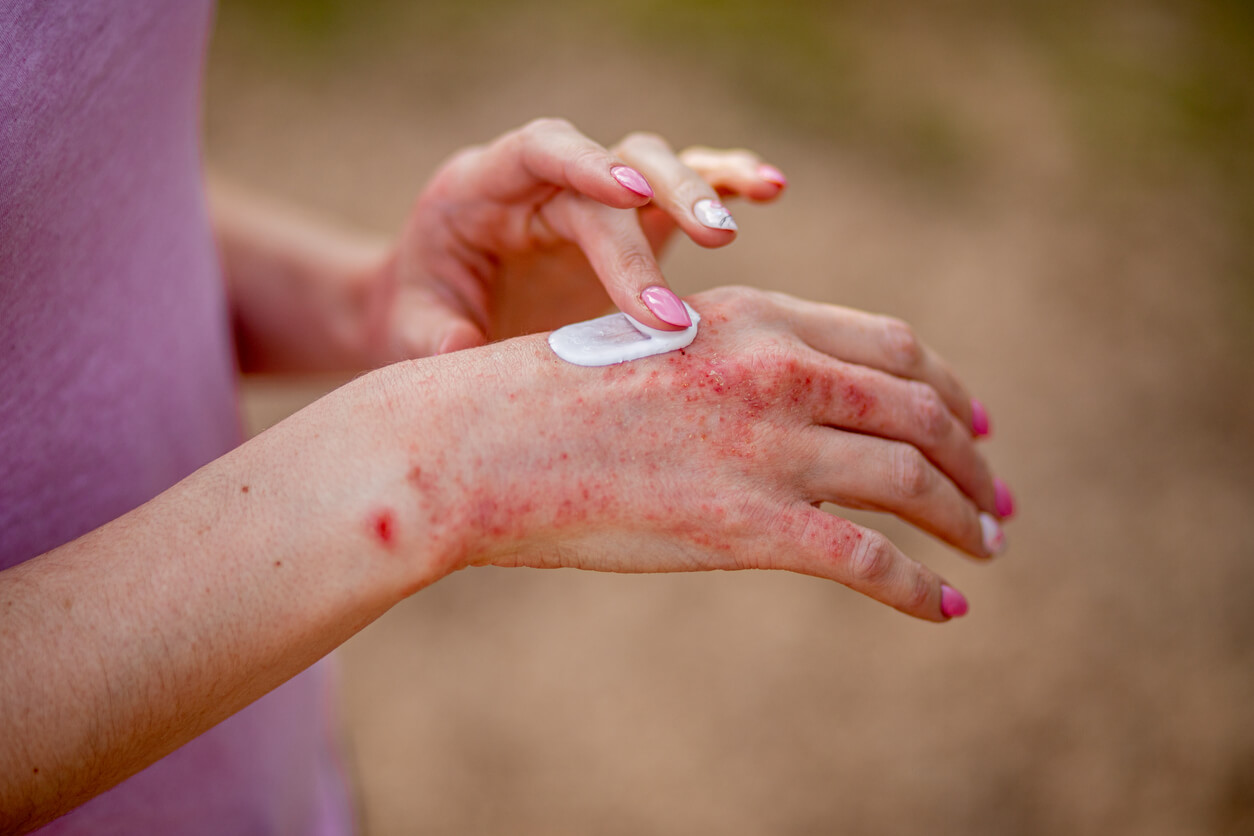 femme appliquant de la crème sur son eczéma