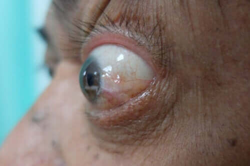 Maladie oculaire thyroïdienne : symptômes, traitements et recommandations