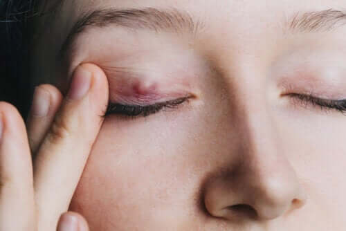 Chalazion : tout ce que vous devez savoir