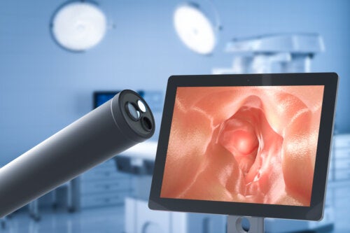 Qu'est-ce que la chirurgie pour traiter le reflux gastro-oesophagien?