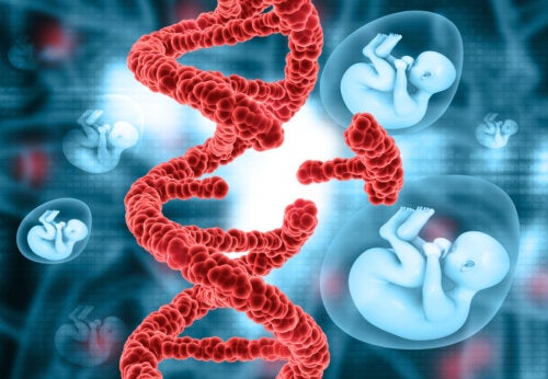 Syndrome d'Edwards : symptômes et causes de la trisomie 18