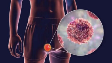 Tératome : types, symptômes et traitements