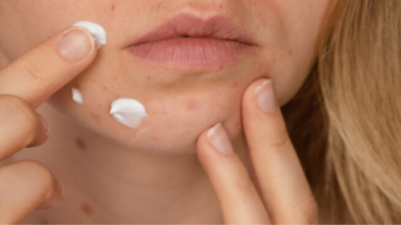 Comment réduire l’inflammation d’un bouton?