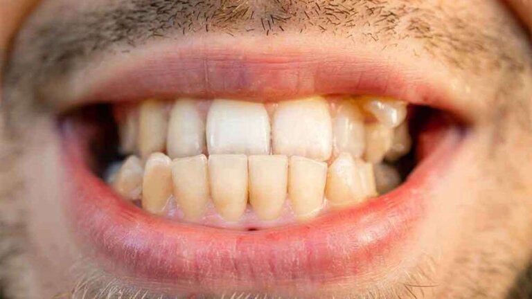 Qu’est-ce que l’occlusion croisée ? Causes et traitements