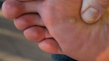 Oeil de poisson sur le pied : symptômes, contagion et prévention