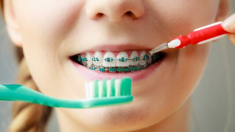 Comment se brosser les dents avec un appareil dentaire?